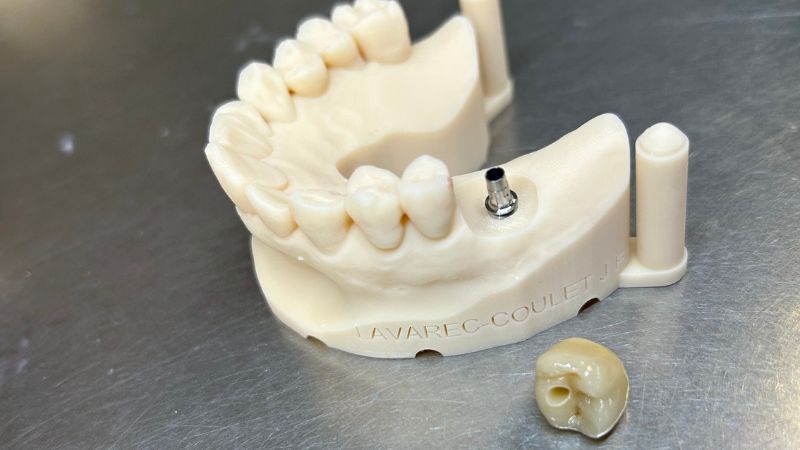 Solutions sur implants