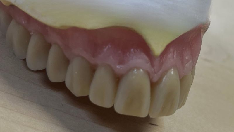 Prothèse dentaire adjointes